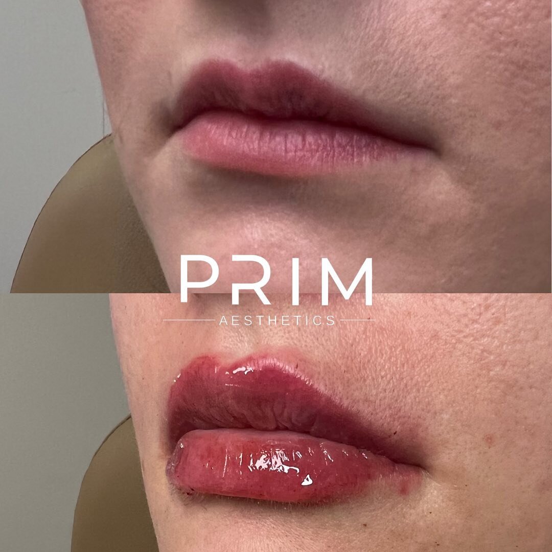 POV: you try lip filler for the first time and now you&rsquo;re obsessed 
We have so many lip filler newbies lately and we love it! Whether you want to address asymmetries, volume or hydration-we got you! Schedule a consultation if you want to ask q