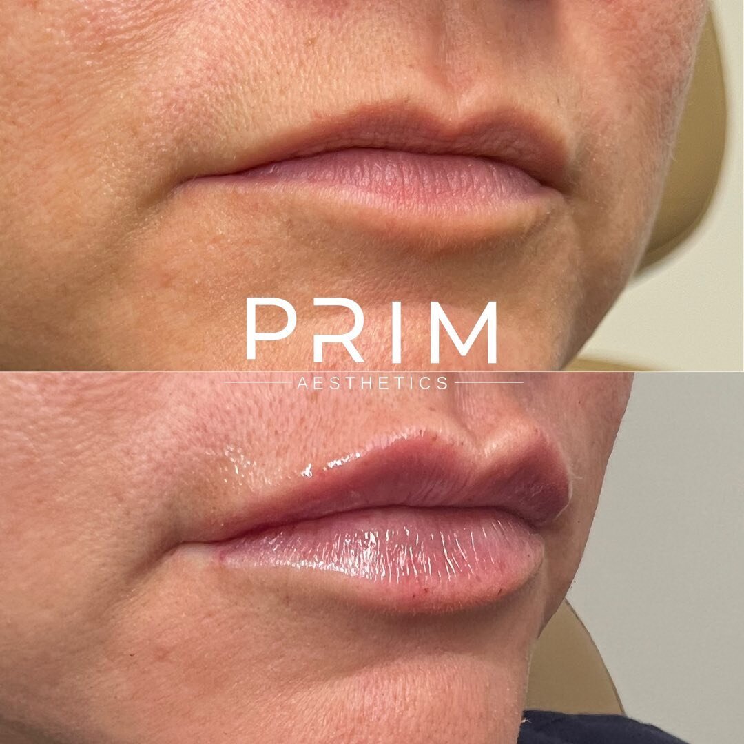 ✨This beauty is loving her results from her first ever lip filler. We used one syringe of Juvederm Ultra Plus to really focus on this gals upper lip and give shaping and hydration. We also did a lip flip with #xoemin to relax her lip up. Ready for yo