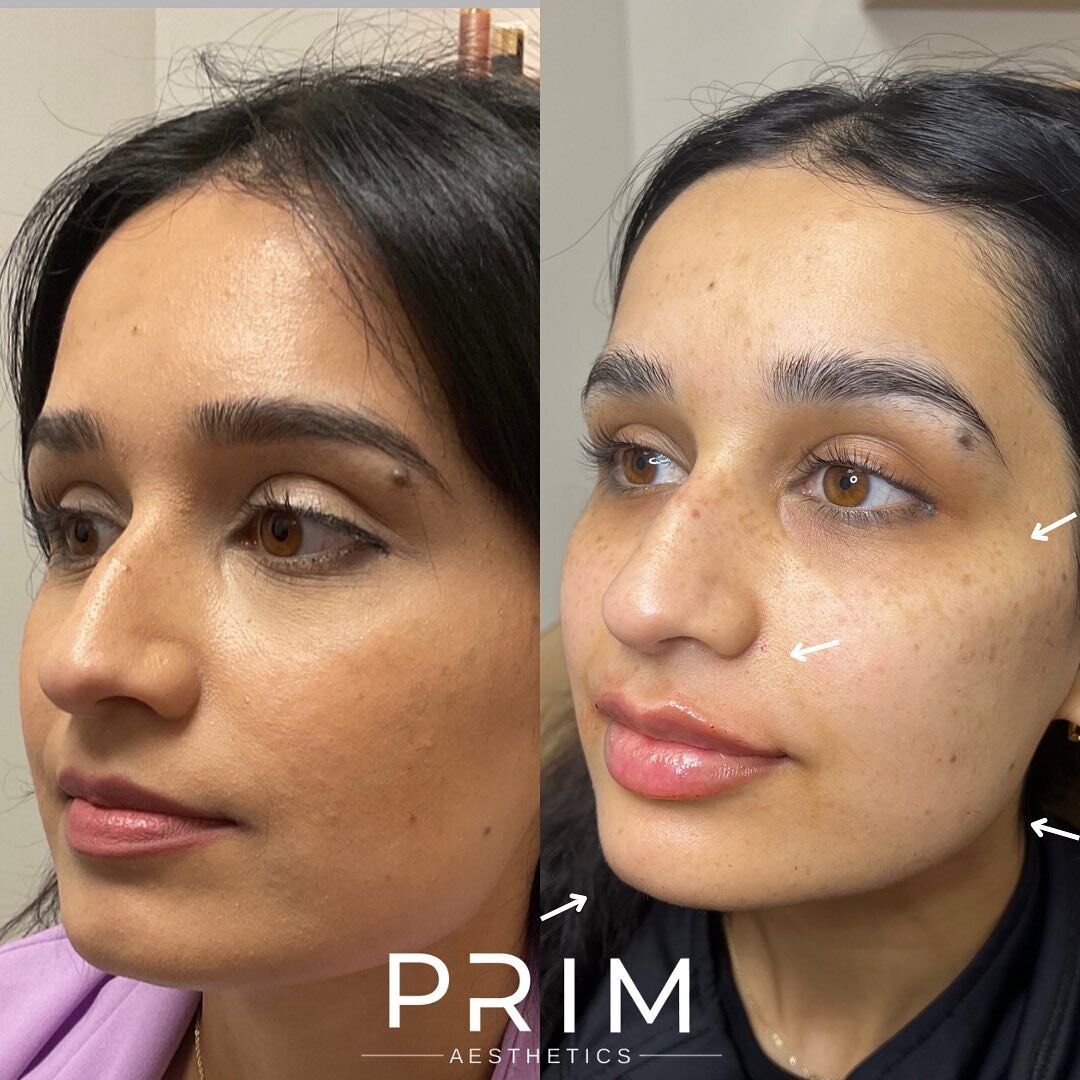 ✨This beauty wanted a little mommy refresh &hellip; we did a series of two 8-Point lifts to give this gorgeous gal some lift and contour. We also did a half a syringe in her lips. ✨
Www.prim-aesthetics.comb
#ProperBeauty #primandproper #8pointfacel